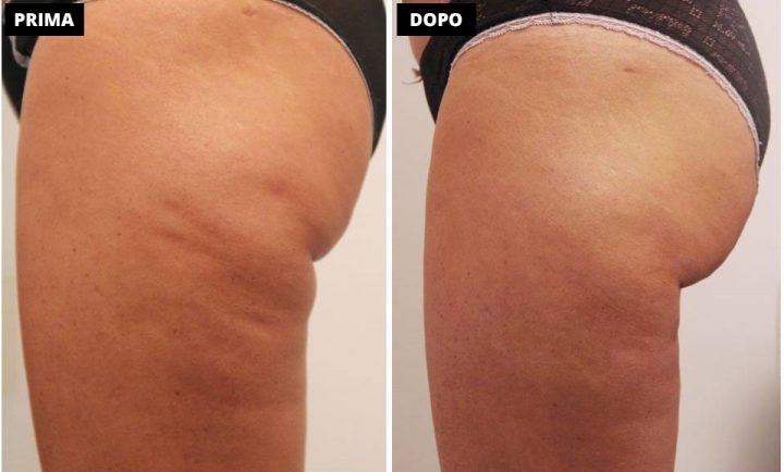 Trattamento Cellulite